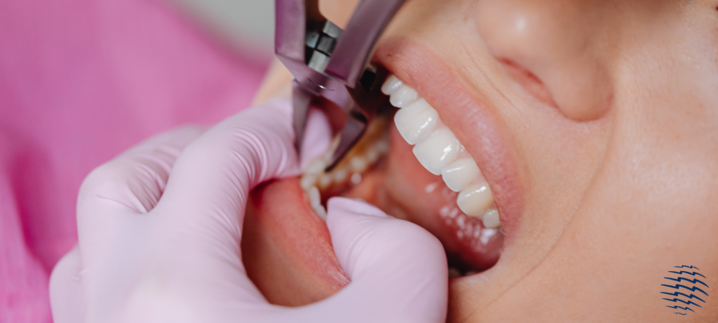 Wisdom Teeth Removal Recovery Tips